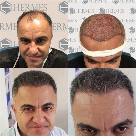 hermes hair clinic saç ekim merkezi i stanbul|saç ekimi istanbul.